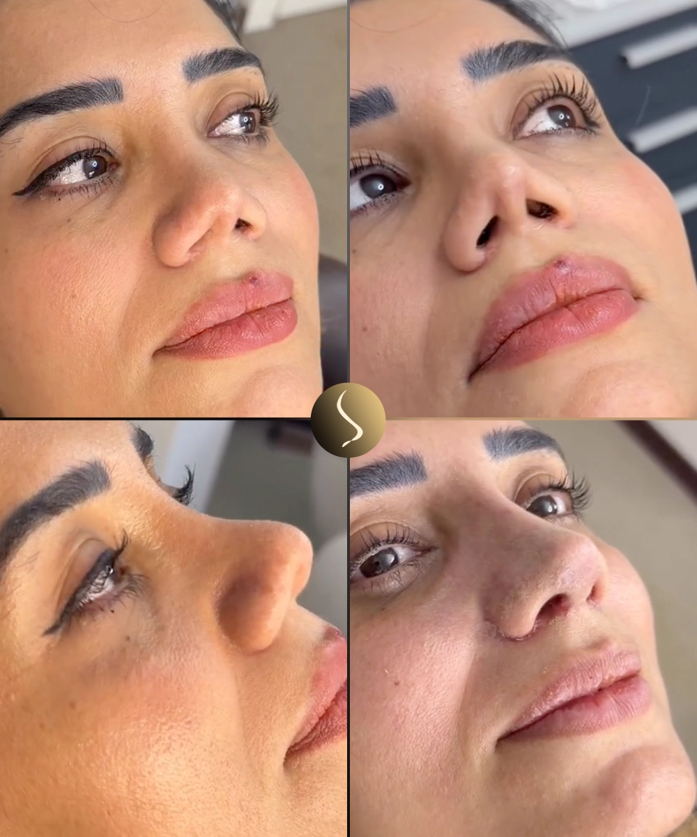 Tip Correction Before & After