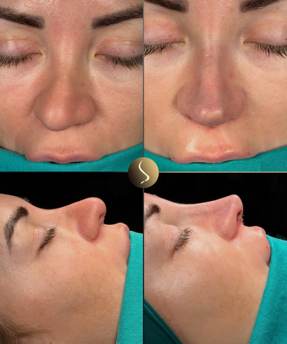 Asymmetry Before & After