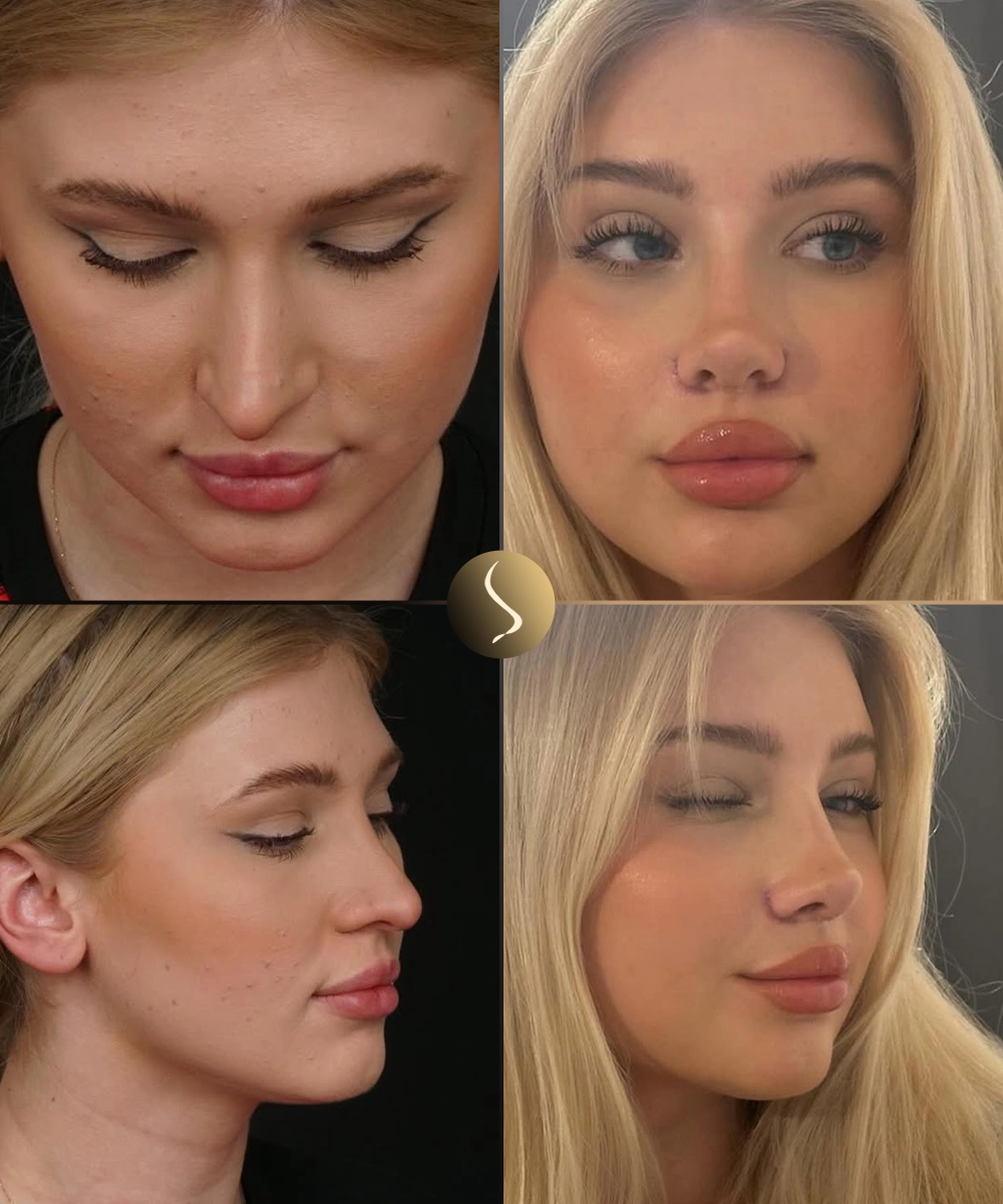 Asymmetry Before & After